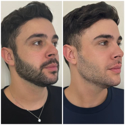 Resultado de Tratamento Tebaris 1