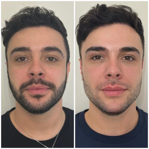 Resultado de Tratamento Tebaris 6